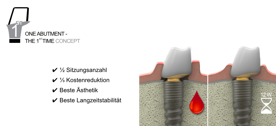 One Abutment - The 1st Time One Abutment - The 1st Time